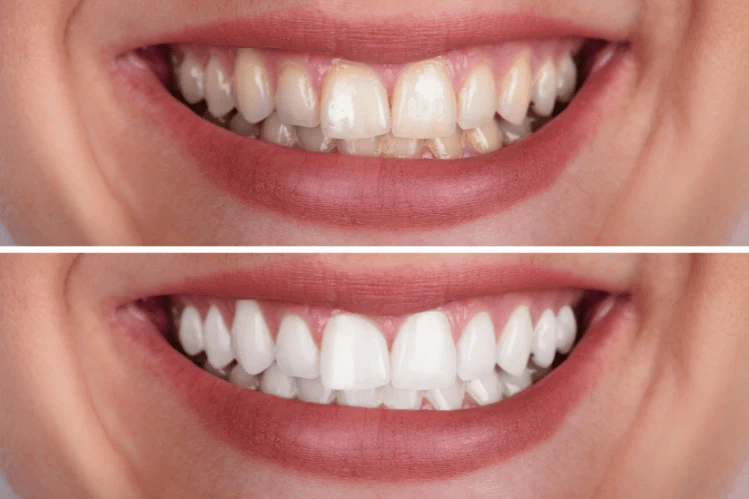 Comparação antes e depois de clareamento dental em paciente da Odonto Pratti